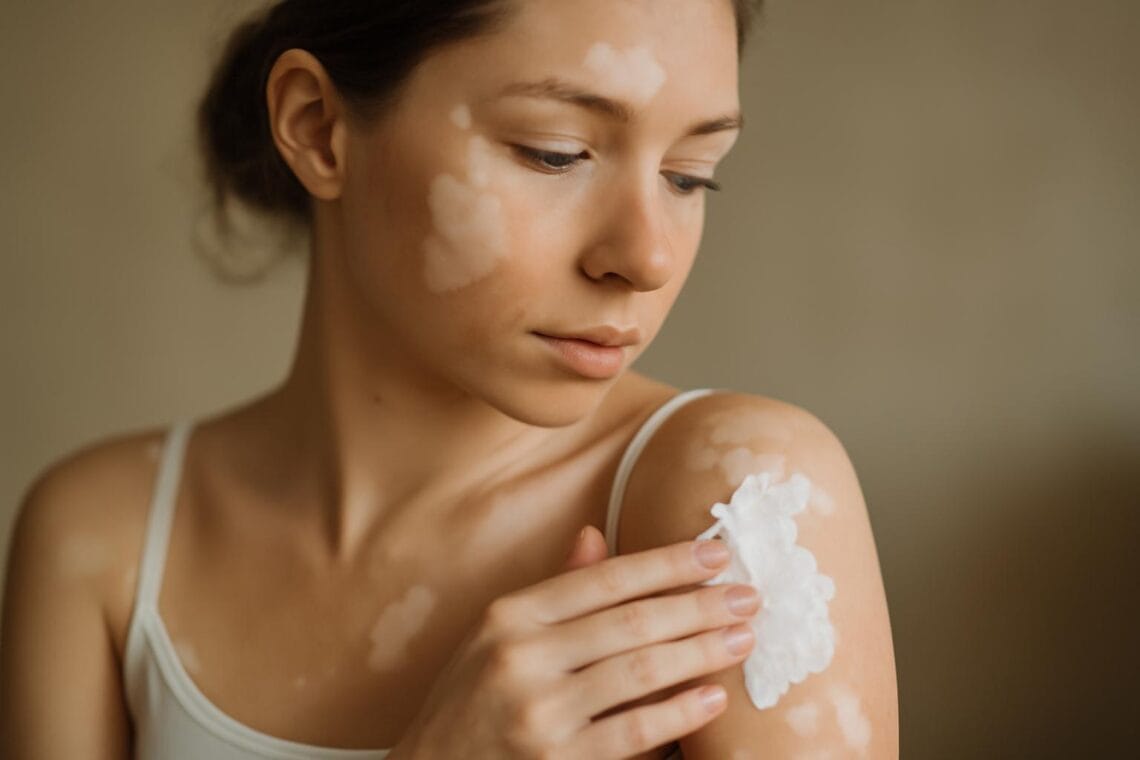 leczenie bia ych plam na skorze metody i zalecenia 2 1