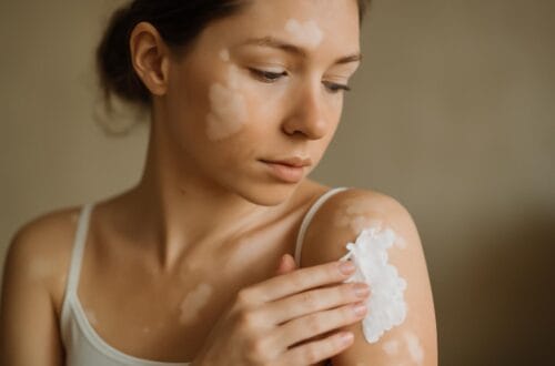 leczenie bia ych plam na skorze metody i zalecenia 2 1